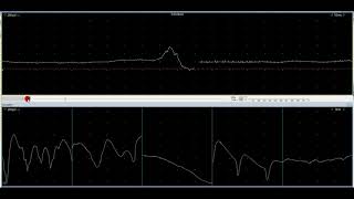 myotonic discharge