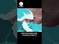 사랑니 발치한 곳에 하얀 게 보인다면 #shorts