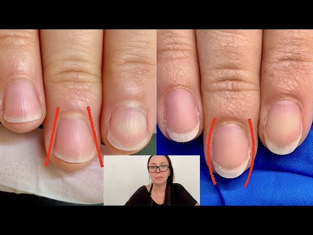 What medical condition is associated with having no cuticle on the  fingernails? - Quora