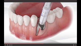 Bond Apatite Socket Preservation With Flap Reflection
