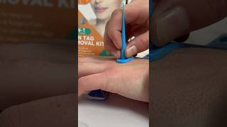 Kit de Eliminación de Verrugas 40 Piezas