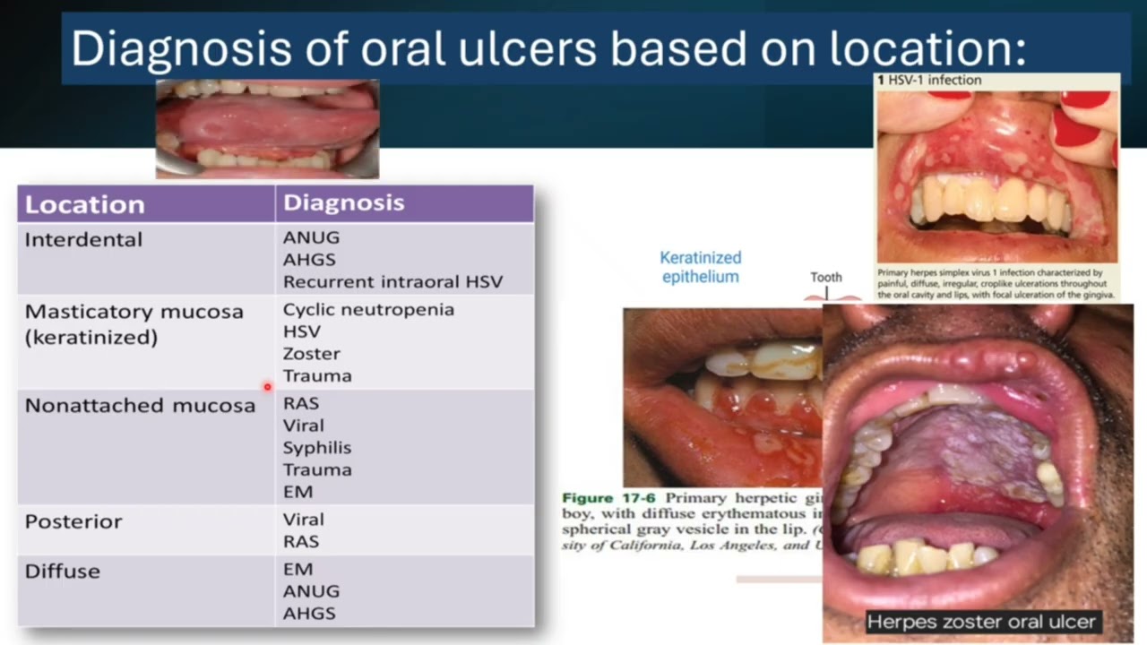 Oral Ulcers د روناء الديب