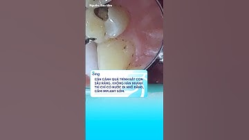 "Con sâu răng" bắt như thế nào? #nhakhoasing #trending #shots #virals