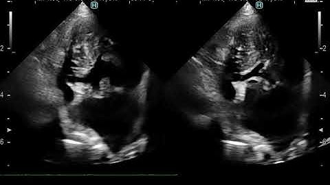 Echo image of the Persistent left superior vena cava in a dog （犬の、静脈遺残、心エコー）