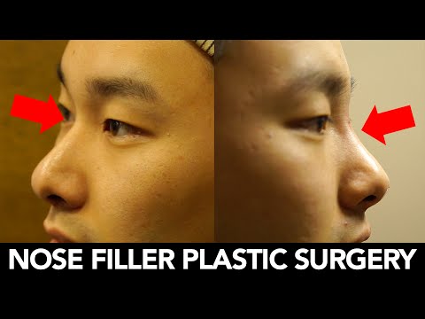 My Nose Filler Surgery Experience Story - Haeppy gets a new nose with nose filler in this video, one of many in our long series of dental, cosmetic, and plastic surgery videos!