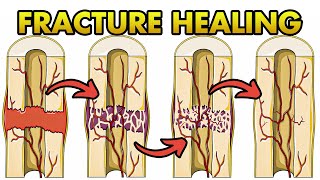 Bone Healing Process Explained in Details