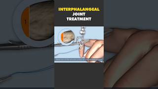 Finger Interphalangeal treatment 3d #science #health #operationdost #3dbio