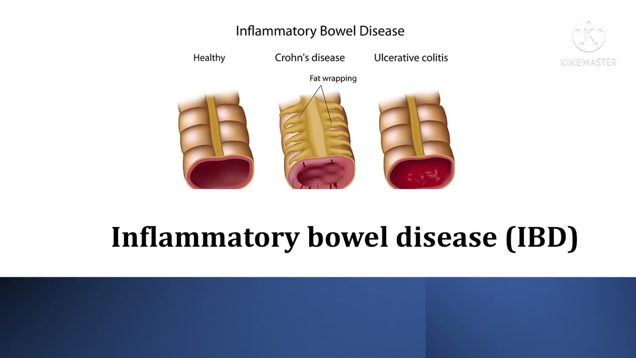 Inflammatory Bowel Disease Ibd Ulcerative Colitis Crohns Disease