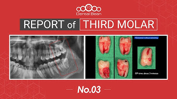 [EMULTI_SUB] Extraction of distoangular Lt. Mn third molar - [Dr. Cho Yongseok]