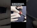 This Cyst is How Old!?