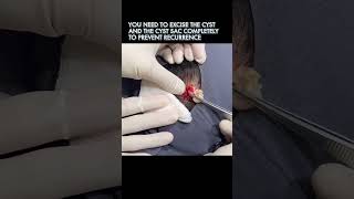 This Cyst is How Old!?