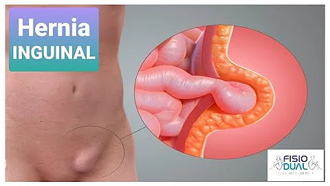 ¿Cómo fortalecer el abdomen después de una hernia inguinal?