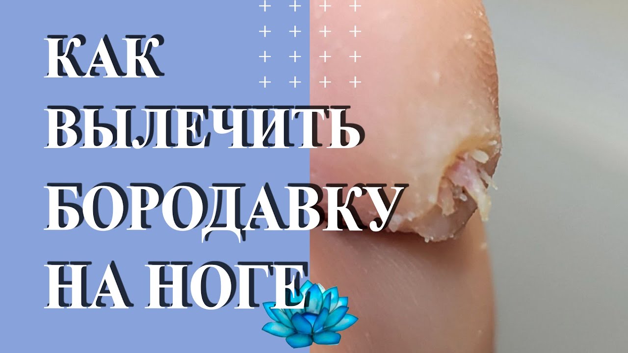 Бородавка на пальце ноги. Вирус папилломы человека лечение. - YouTube