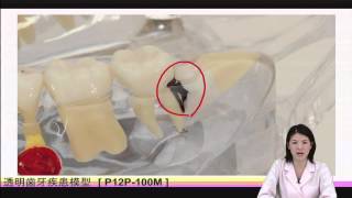 疾患説明用透明顎模型 [PE-TDS001] (旧型番：P12P-100M)