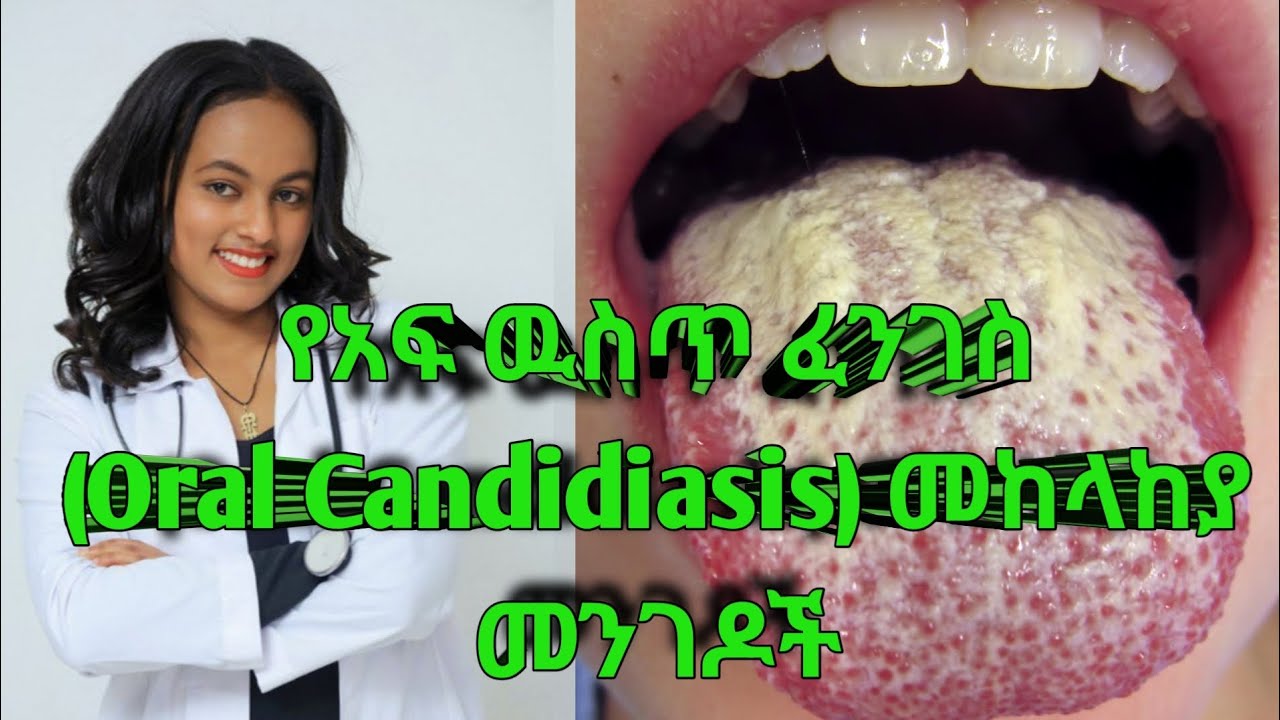 የአፍ ውስጥ ፈንገስ (Oral Candidiasis) መንስኤዎች እና መከላከያ መንገዶች#oralcanidiasis#oralhealth#oralhygienetips#oral