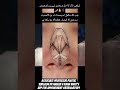 #NoseCorrection#DeviatedNoseSurgery#skincare #NoseJob
