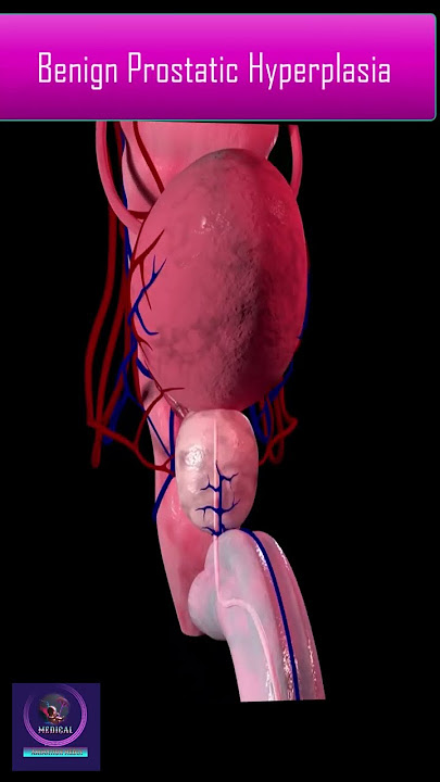 Benign Prostatic Hyperplasia - View in 3D animation