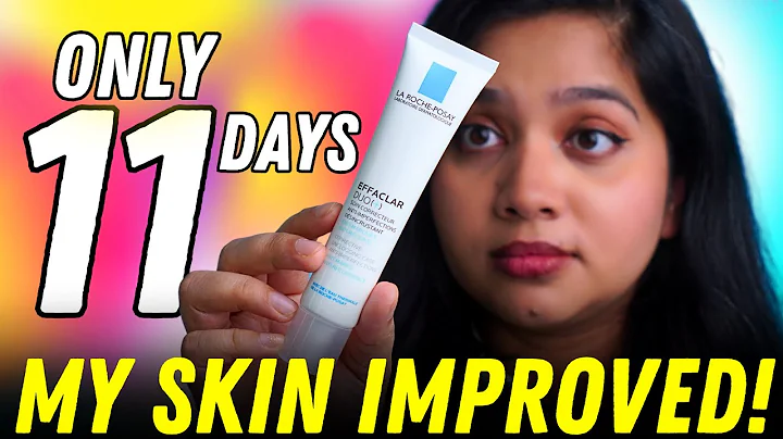 😲 Improve Your Skin in Just 11 Days! My Before & After Results with La Roche-Posay Effaclar Duo