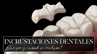 ¿Qué es y cuándo se realiza una incrustación dental?