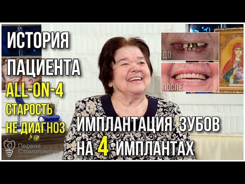 Имплантация зубов на 4 имплантах. История пациента.