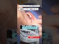奥歯が複数本ない場合、インプラントの上に歯が入る間は入れ歯を使用しなければいけないことが主でした。今クリでは仮歯用の細いインプラントを入れて入れ歯を使わずに過ごしていただくことが可能です#インプラント