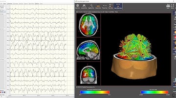 NeuroNavigator Epilepsy Example for Neurologist