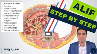 Anterior lumbar interbody fusion (ALIF) - Step by step procedure details, anatomy, &amp; recovery review