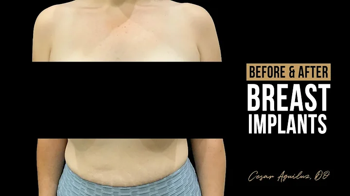 Before After Breast Implants #046  Dr. Cesar Aguil...