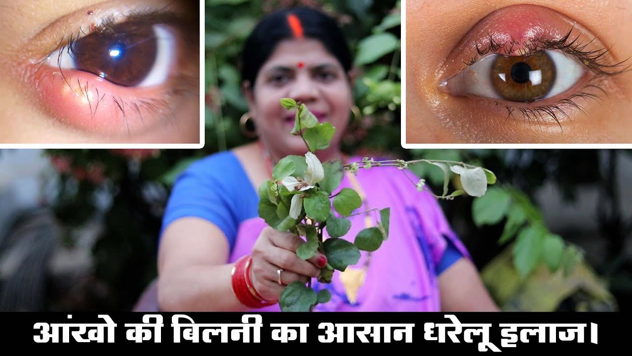 आंख की बिलनी से बचाव और घरेलू उपचार