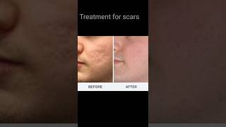 Treatment for acne scars ytshorts scars tips shorts shortvideo viralvideo youtubeshorts