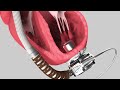Axs studio medical device animation show reel