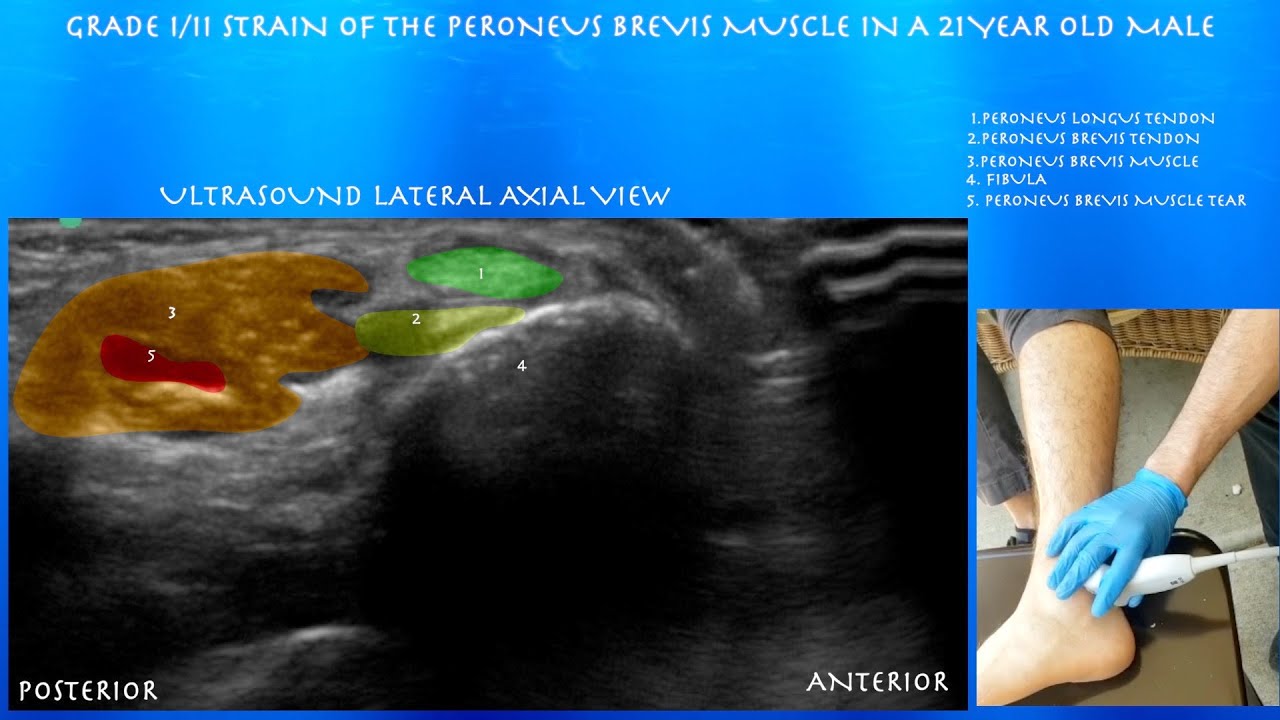 Ultrasound Of A Peroneus Brevis Strain In A 21 Year Old Male By ultrasound-of-a-peroneus-brevis-strain-in-a-21-year-old-male-by