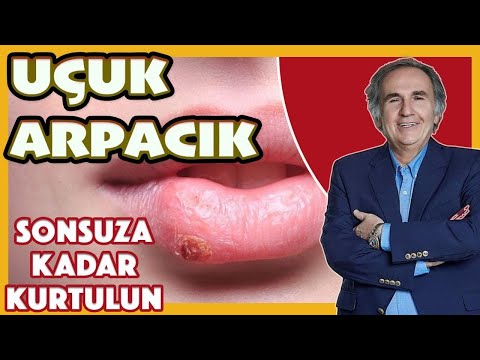 UÇUK VE ARPACIKTAN SONSUZA KADAR KURTULUN.#uçuk #arpacık #ibrahimsaraçoğlu. #