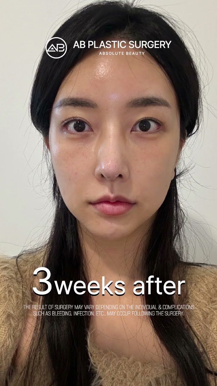 [Best Plastic Surgery in Korea] Facial Contouring Surgery + Revision Rhinoplasty #abplasticsurgery
