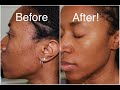 How To Get Rid of Moles and Dark Spots Fast (DPNS)