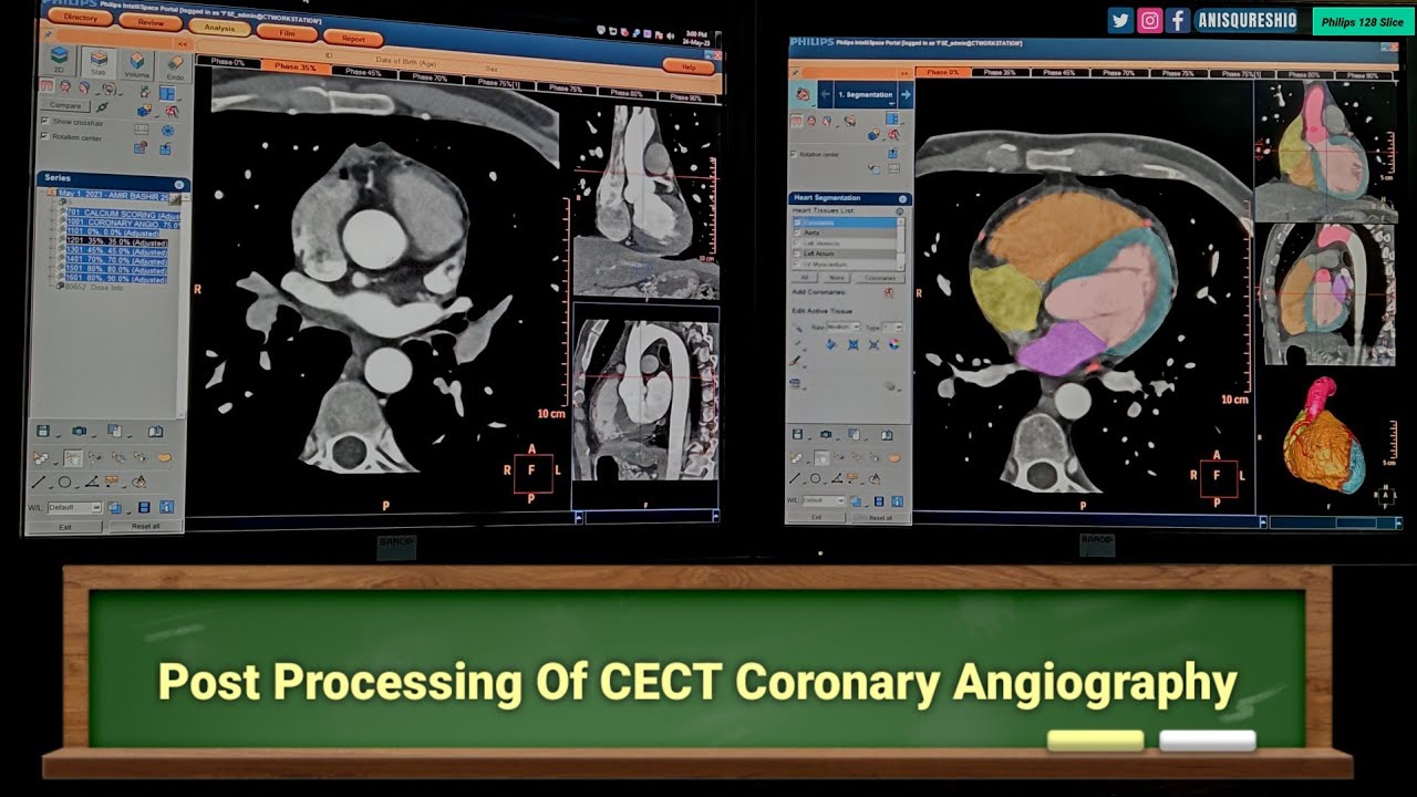 Post Processing of CECT Coronary Angiography| By Anis Qureshi