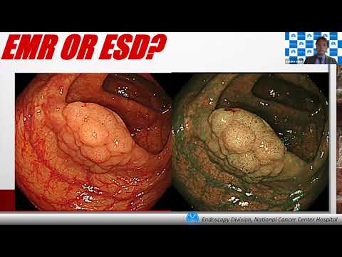 JNET diagnosis & EMR/ESD for colorectal tumors - Prof. Yutaka Saito