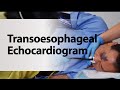 Transoesophageal Echocardiogram