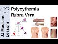 Polycythemia Rubra Vera | Pathophysiology, Symptoms, Diagnosis and Treatment