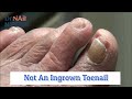 Surprise, It's Not an Ingrown Toenail [Throwback Thursday Bonus]