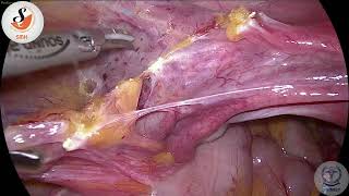 TLH with Bilateral Salphingectomy with Challenging Adhesiolysis in a Case of Previous 2 LSCS