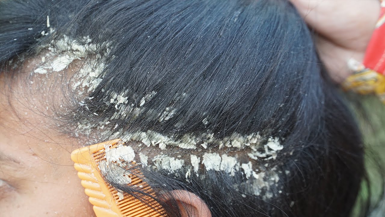 Dandruff Removal Long Hair Guys 