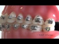 Les incidents orthodontiques