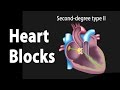 Heart Blocks, Anatomy and ECG Reading, Animation.