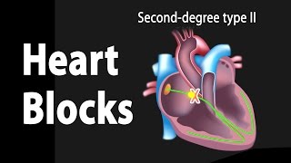 Heart Blocks, Anatomy and ECG Reading, Animation.