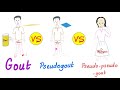 Gout Vs Pseudogout Vs Hydroxyapatite Arthropathy