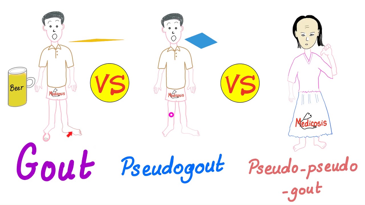 gout vs pseudogout crystals
