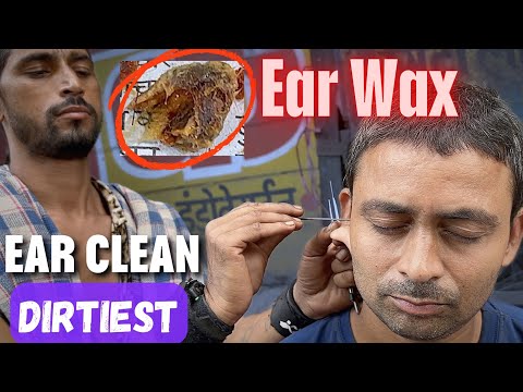 Dirtiest Ear Wax found During Ear Cleaning at Street Side Ear Cleaner | ASMR