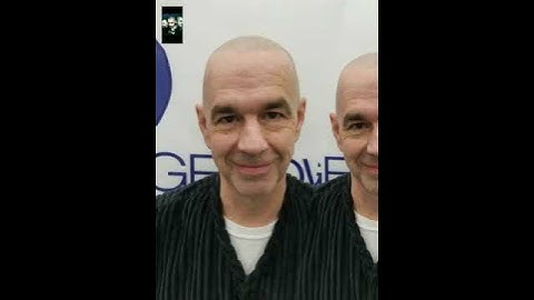 Exposed Scalp Micropigmentation truth behind