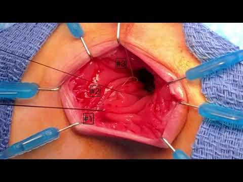 Biopsia de recto para diagnóstico de Hirschsprung